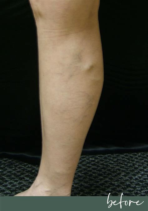 varicose vein treatment mt juliet